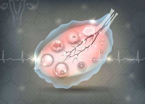 多囊卵巢是卵巢早衰吗？试管婴儿的一大障碍！